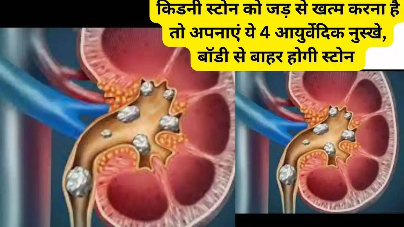 Kidney Stone: If you want to eliminate kidney stone from the root, then follow these 4 Ayurvedic remedies, the stone will be out of the body